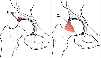 pincer and cam lesion hip impingement